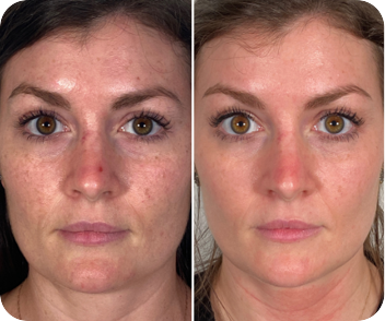 Woman's before and after RF microneedling at Luminous