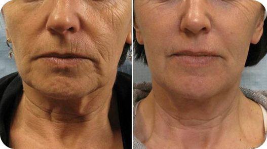 Before and after Tixel treatment at Luminous