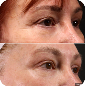 Tixel treatment at Luminous around eyes before and after