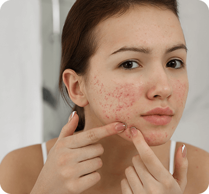Woman looking at her acne