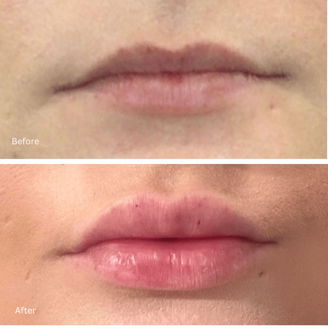 Lip filler before and after treatment at Luminous