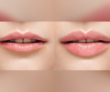 Before and after lips filler